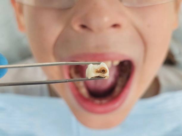 Best Emergency Tooth Extraction in Plainview, NE